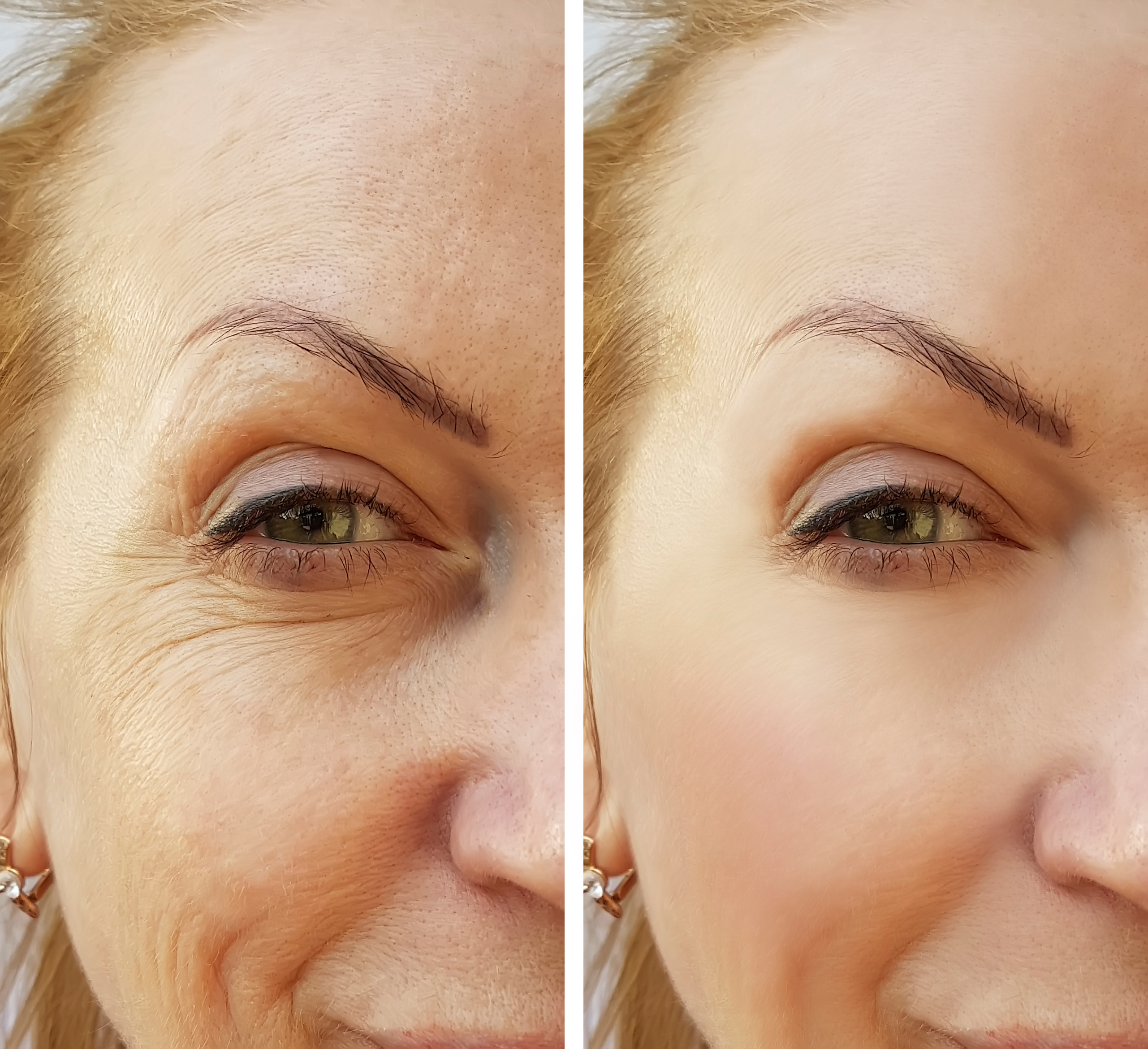 Injectable treatment at Laser Me in St. Louis